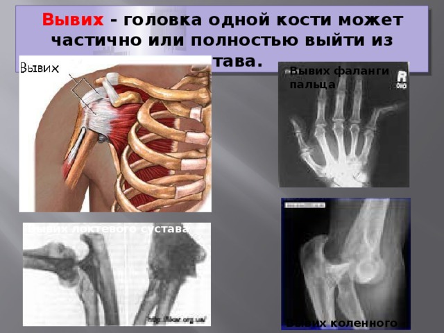 Вывих - головка одной кости может частично или полностью выйти из сустава. Вывих фаланги пальца Вывих локтевого сустава Вывих коленного сустава