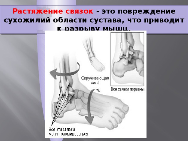 Растяжение связок - это повреждение сухожилий области сустава, что приводит к разрыву мышц.