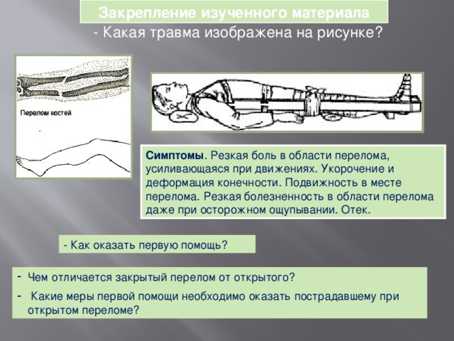 Закрепление изученного материала  - Какая травма изображена на рисунке? Симптомы . Резкая боль в области перелома, усиливающаяся при движениях. Укорочение и деформация конечности. Подвижность в месте перелома. Резкая болезненность в области перелома даже при осторожном ощупывании. Отек. - Как оказать первую помощь? Чем отличается закрытый перелом от открытого?  Какие меры первой помощи необходимо оказать пострадавшему при открытом переломе? 20