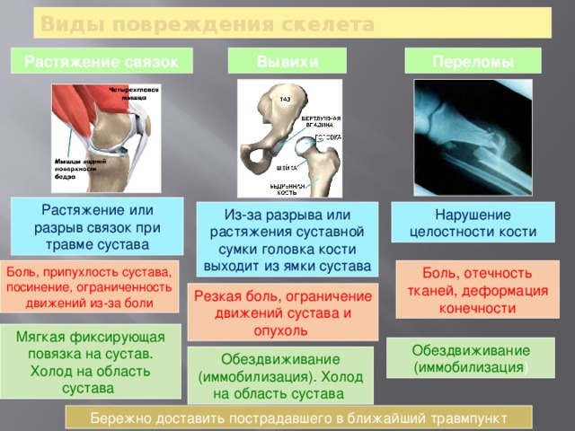 Виды повреждения скелета Вывихи Переломы Растяжение связок Растяжение или разрыв связок при травме сустава Нарушение целостности кости Из-за разрыва или растяжения суставной сумки головка кости выходит из ямки сустава Боль, отечность тканей, деформация конечности Боль, припухлость сустава, посинение, ограниченность движений из-за боли Резкая боль, ограничение движений сустава и опухоль Мягкая фиксирующая повязка на сустав. Холод на область сустава Обездвиживание (иммобилизация ) Обездвиживание (иммобилизация). Холод на область сустава Бережно доставить пострадавшего в ближайший травмпункт 20