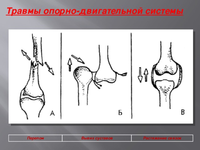 Травмы опорно-двигательной системы  Перелом Вывих суставов Растяжение связок