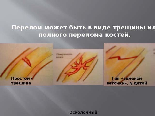 Перелом может быть в виде трещины или полного перелома костей. Простой - трещина Тип «зеленой веточки», у детей Осколочный